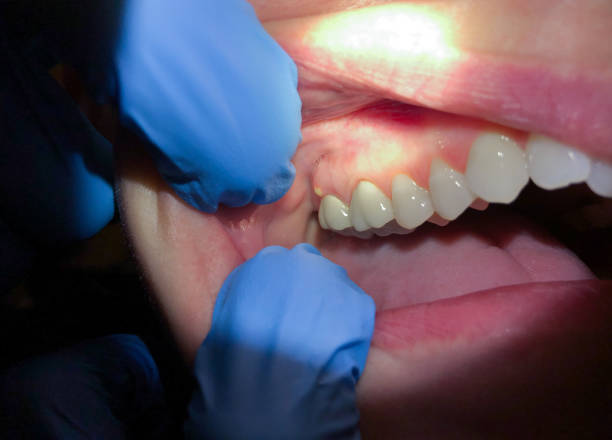 Best Emergency Wisdom Teeth Removal in Upland, PA